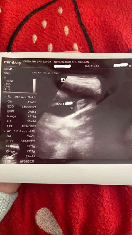 GENDER SCAN ( BOY OR GIRL )