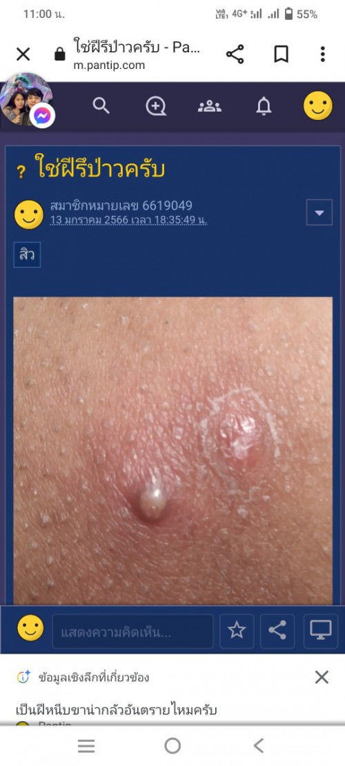 ท้อง34วีค ไม่รู้เป็นสิวหรือฝี ที่จิมิค่ะ