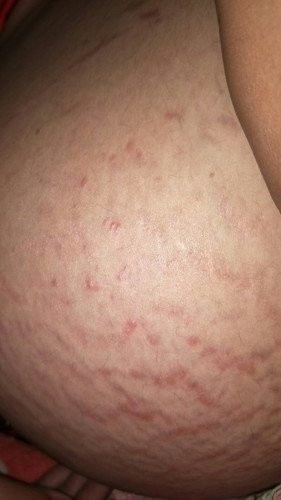 สอบถามน่อยค่ะเปนผื่นคันแบบนี้ที่ท้องคันมาก อันตรายไหมคะ. แล้วทำยังไงถึงจะหายทายาแล้วไม่ดีขึ้นเลยค่ะ