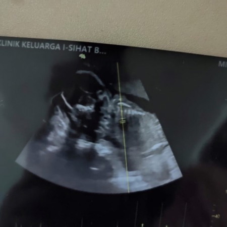 Saya pergi scan gender semlm betul ke baby girl  dr pun mcm Tk sure hmm