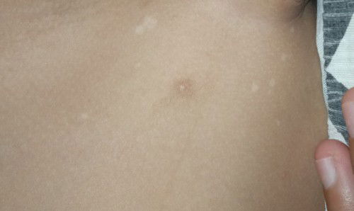 Bercak putih makin banyak