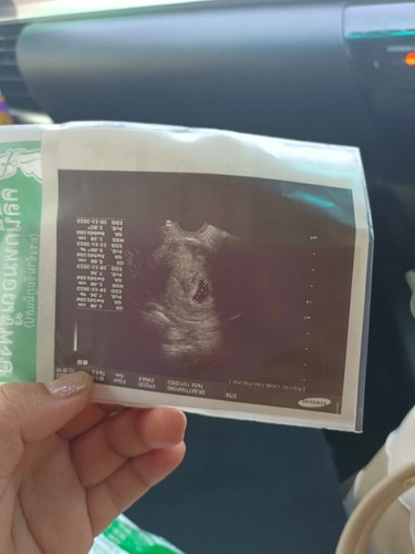 ซาวด์ทางช่องคลอด 7wk ไม่เจอตัวเด็ก หมอวินิจฉัยท้องลม เสียใจมากคะ 😭😭😭