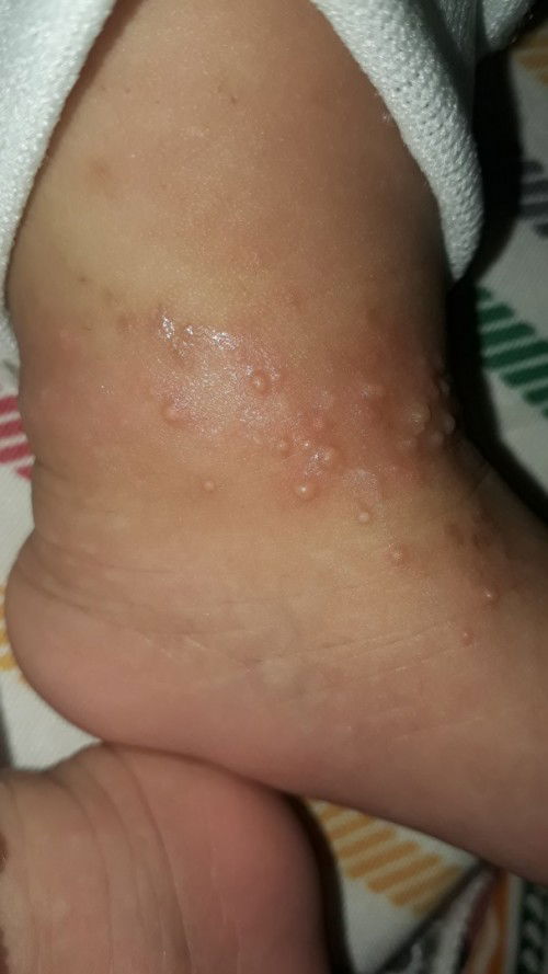 Gatal pada bayi 1bulan