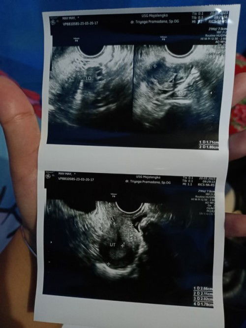 Hasil usg transvaginal