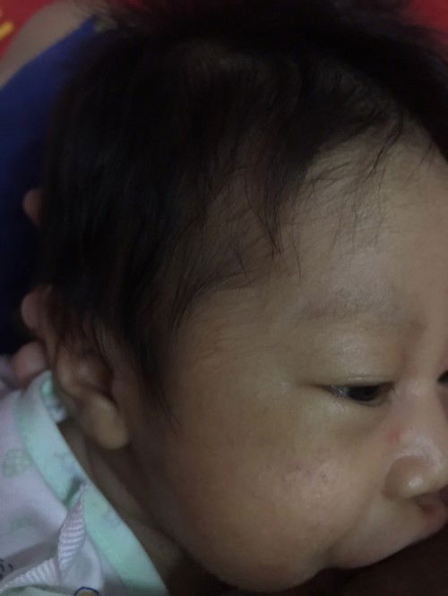 ผื่นขึ้นแบบนี้ปกติไหมค่ะเป็นที่ตาด้วยกังวลมากเลยค่ะ