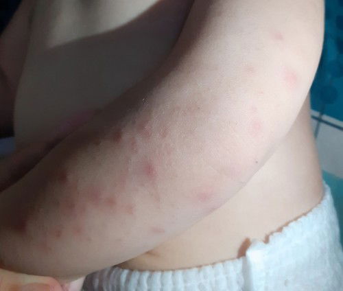 Bintik merah pada bayi