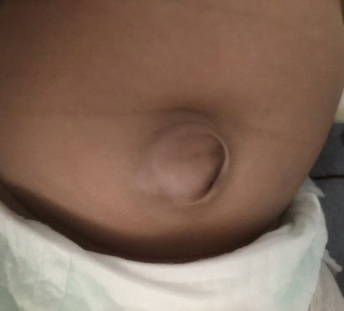 แม่ๆบ้านไหนน้องสะดือเป็นแบบนี้บ้างคะ