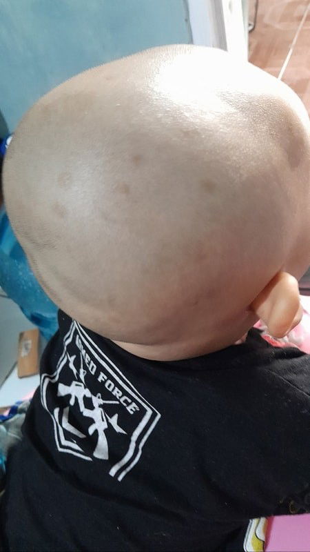 Bercak coklat pada kulit bayi