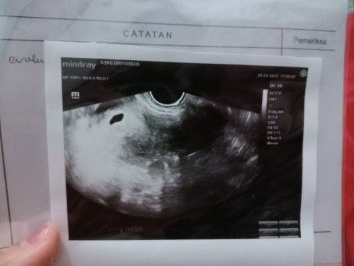 5 week belum ada janin