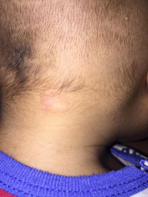 แบบนี้คือเป็นอะไรคะ กลากรึเปล่าคะ