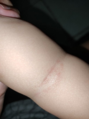 Dry patch / rashes