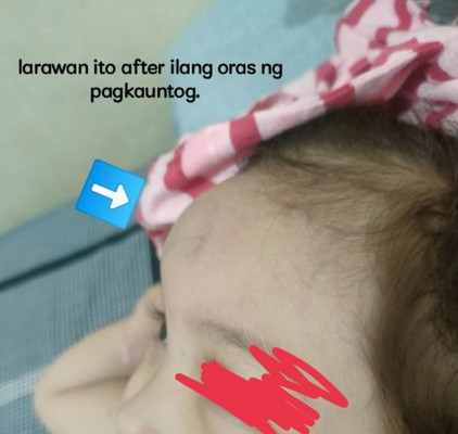 BUKOL sa noo