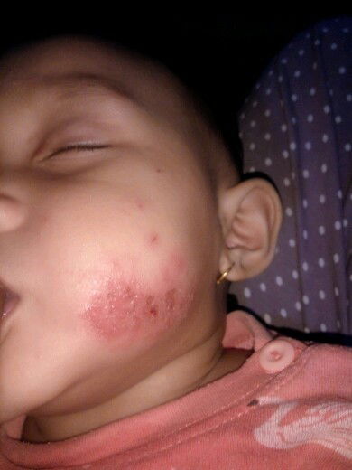 ruam pipi tak kunjung sembuh