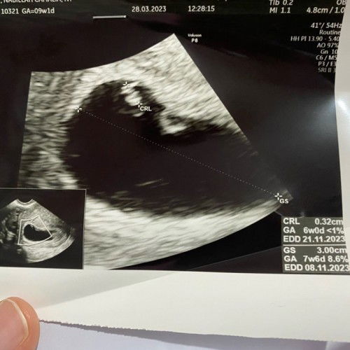 Janin tidak berkembang?