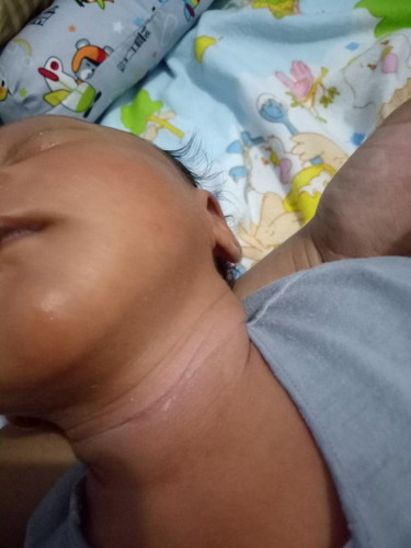 Bunda ada yg tau ini knpa ya? Daerah lipatan sprt leher selangkangan pada begn, trs kasi apa ya bund