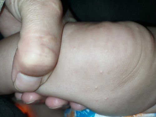 Các mon cho e hỏi bé bị như này phải lấy j bôi ạ ..