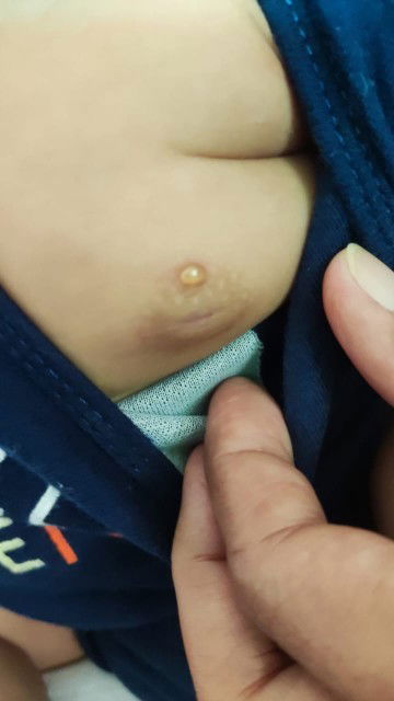 Timbul biji yg berair dekat susu baby..
Mau tnya ada yg tau itu apa n cara Untk mengubatinya..