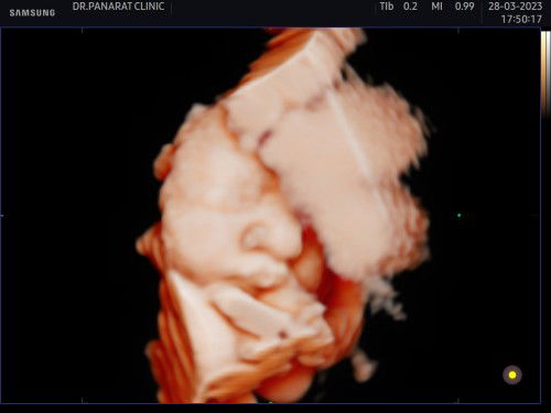 อัลตร้าซาวด์ 4 มิติ