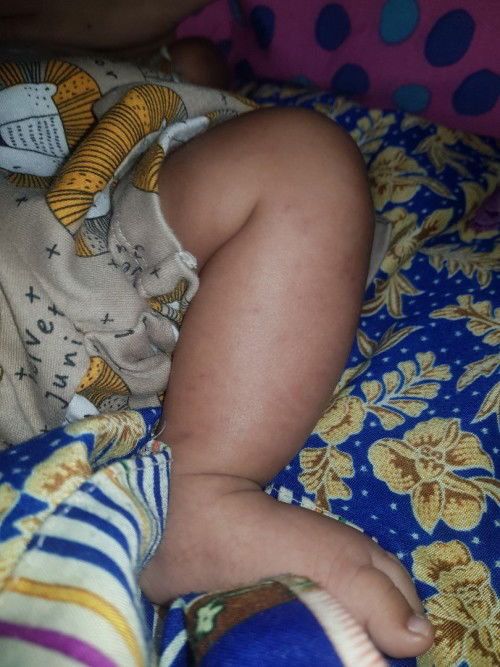 Seperti digigit serangga