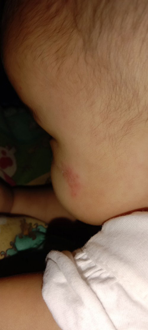 Hemangioma