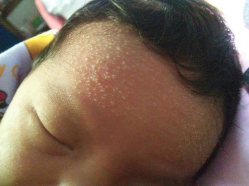 ผดผื่น แพ้สบู่อาบน้ำ