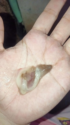 Mucus plug?