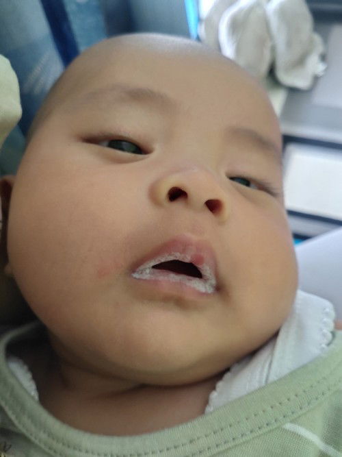 Lidah putih pada bayi
