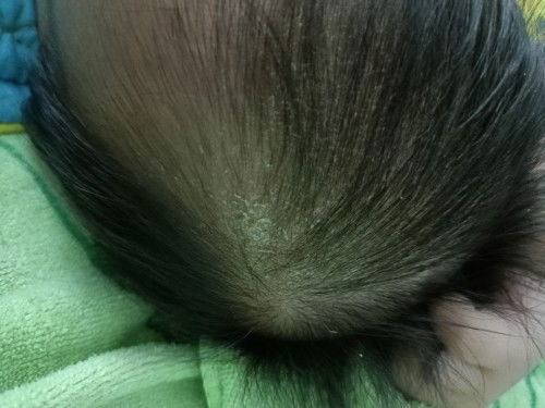 Làm sao để sạch mảng bám trên da đầu bé