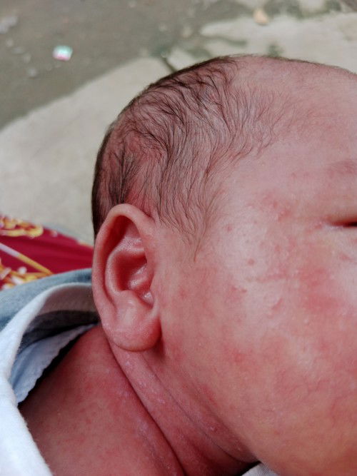 Merahh di badan bayi