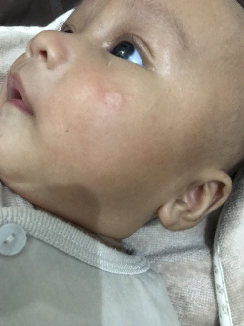 Ruam di pipi