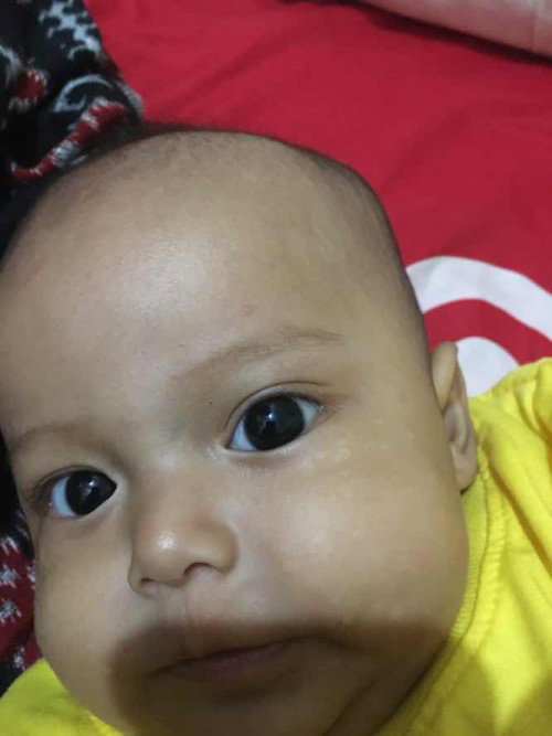 Bintik putih seperti panu diwajah bayi