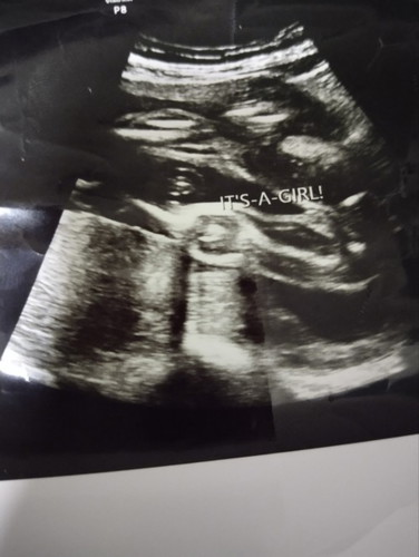 Scan gender Ms 24week 28 week .