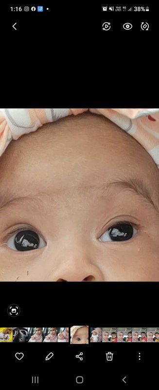 Adakah ini ptosis ke lazy eye