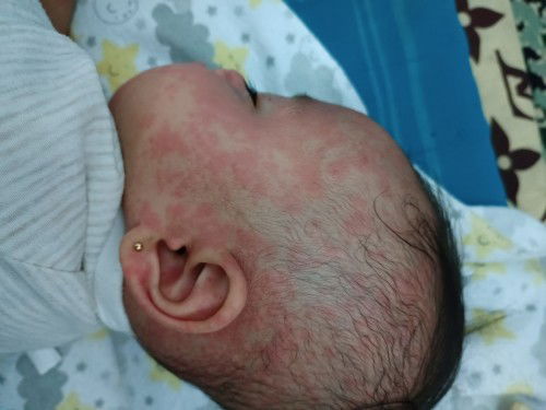 Cara menghilangkan/menyamarkan ruam campak