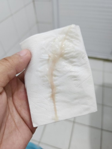 Discharge on 34th wk