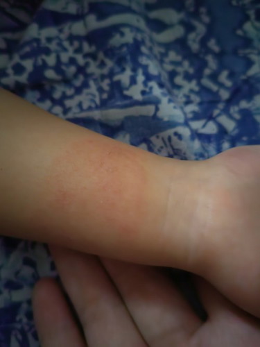 Anong allergy po kaya ito sana my makasagot sa food po b kaya???