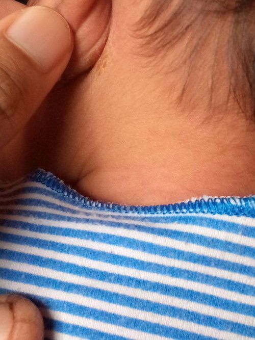 Lecet belakang telinga