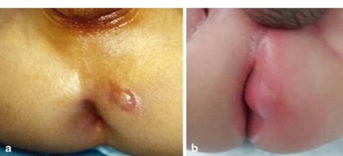 Perianal Abscess  (1 1/2 month old)