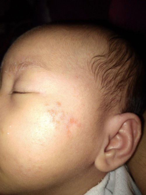 Parang rashes sa mukha