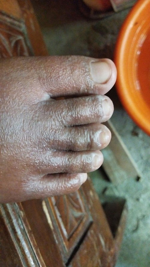 Kutu air sampe bengkak kaki minta solusinya donk bun...