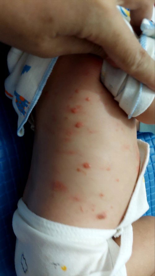 Bentol2 merah di bayi