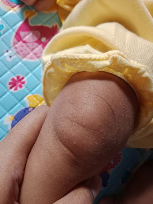 Bintik2 kecil di siku dan lutut