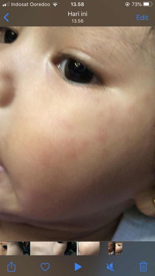 Keringatan akhirnya merahmerah