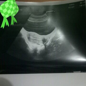 Nanya tentang kehamilan