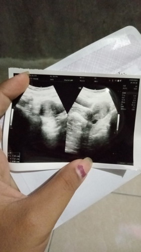 Hasil USG?kata dokter blm kelihatan apa cuma sudah membesarkan rahim,tp yg bulat itu apa ya Bun?
