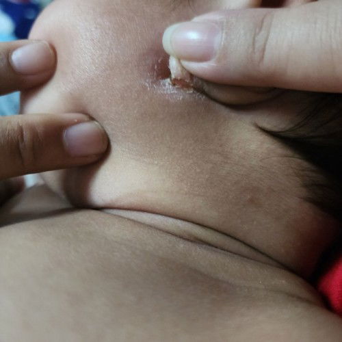 ลูกหูเปื่อย แห้งเป็นขุ่ย และมีน้ำเหลืองใสๆ ไหล