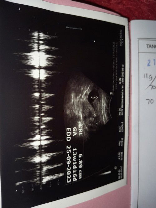 Minggu lalu saya keluar darah banyak bun, usg janin bagus & djj jg bagus sekarang saya berdarah lg .