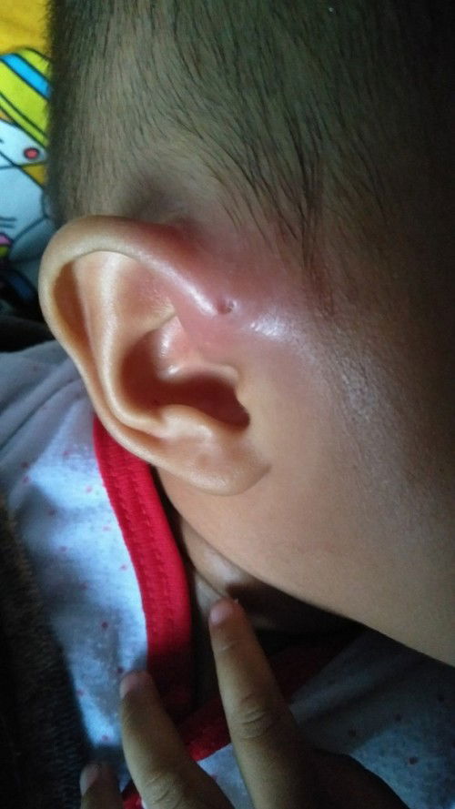 Daun telinga bengkak