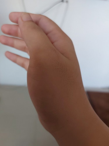 Pananakit ng kamay : 3 months Postpartum