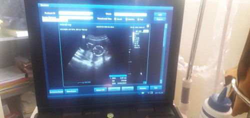 bun ada yang sama hpl 10 juni 2023 tapi aku lupa hpht,nah tau hpl ny itu pas usg bulan januari